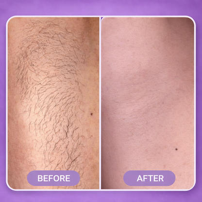 SilqueSkin™ Hair Removal